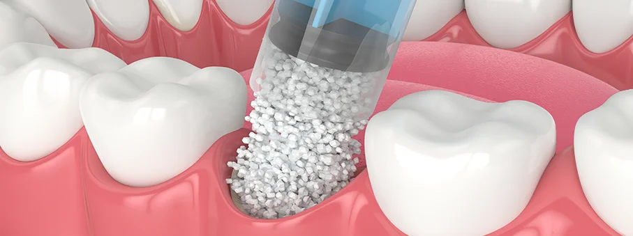 Bone grafting materials are proven safe and sterile for use in the human jaw