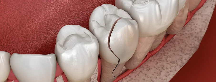 Tooth coloured fillings for repairs to chipped teeth